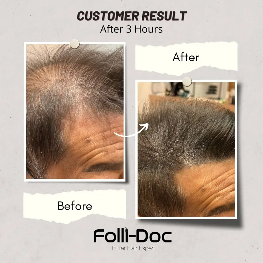 Folli-Doc customer result, before and after one session