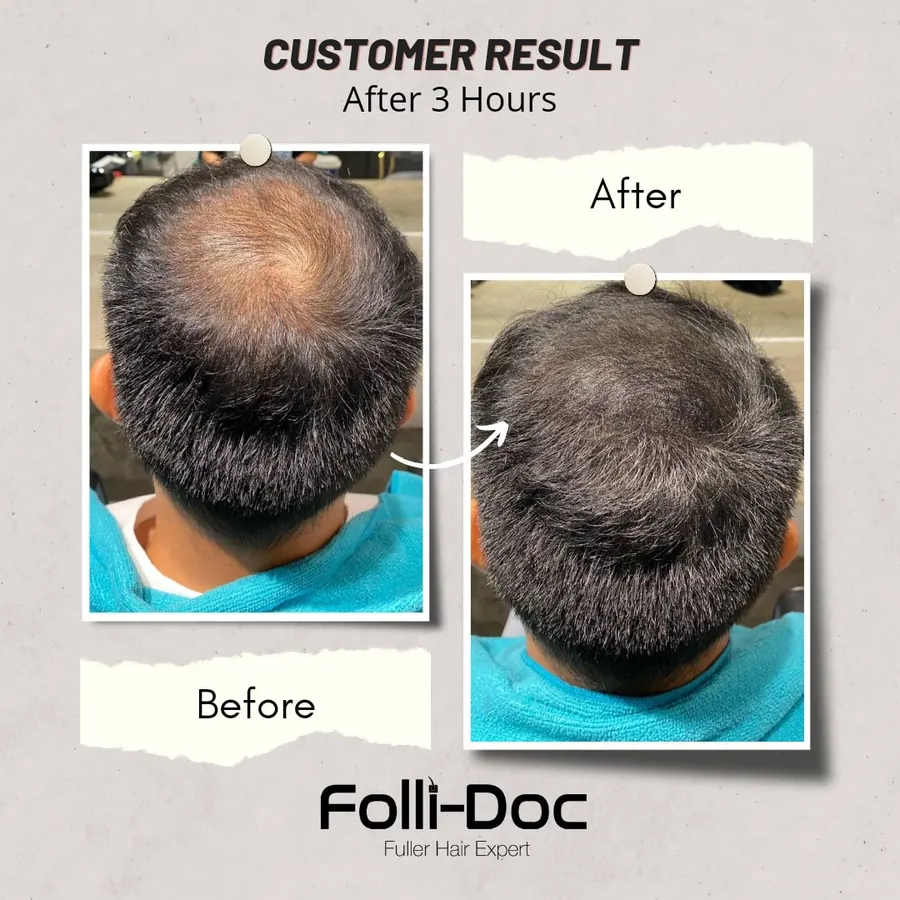 Folli-Doc customer result, before and after one session