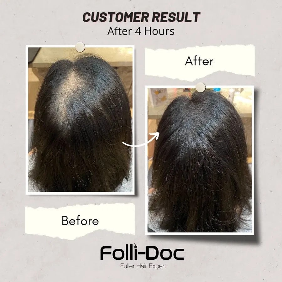 Folli-Doc customer result, before and after one session
