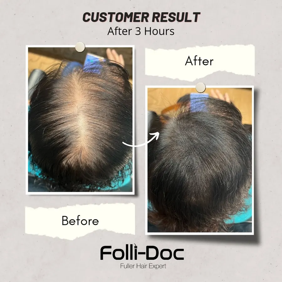 Folli-Doc customer result, before and after one session