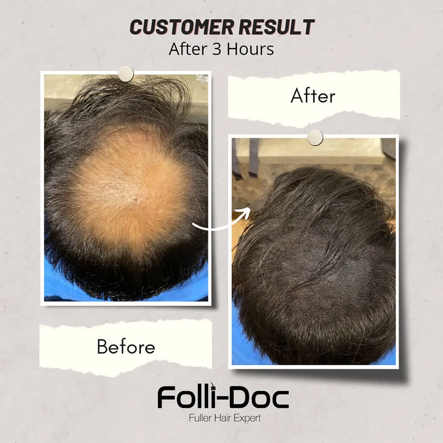 Folli-Doc customer result, before and after one session