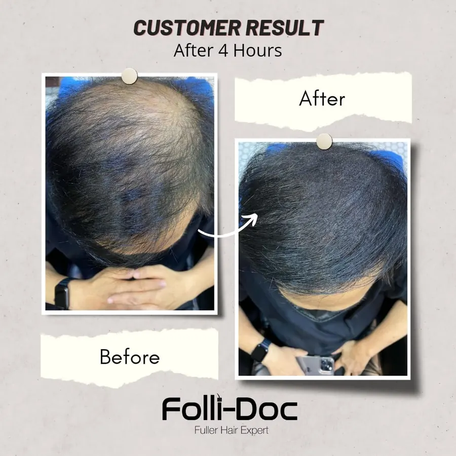 Folli-Doc customer result, before and after one session