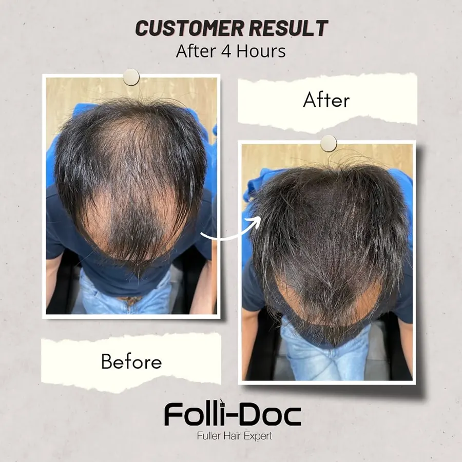 Folli-Doc customer result, before and after one session