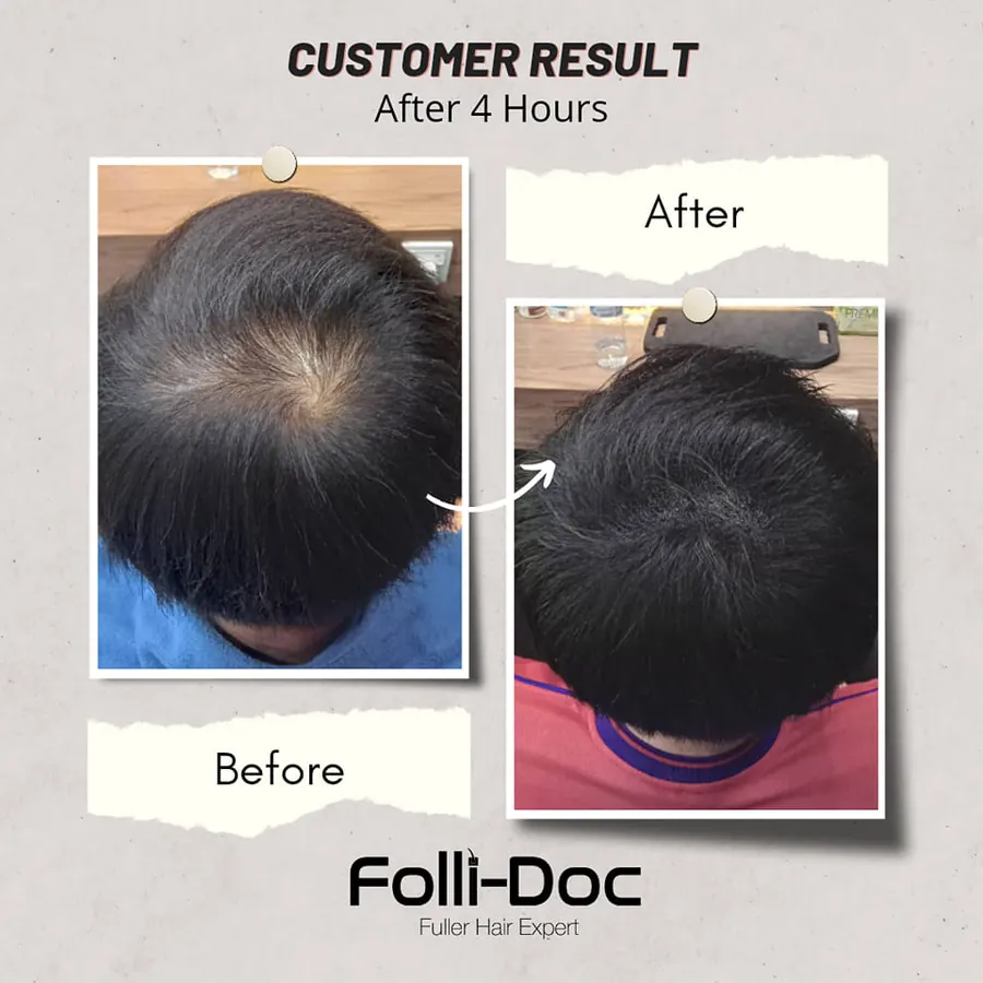 Folli-Doc customer result, before and after one session