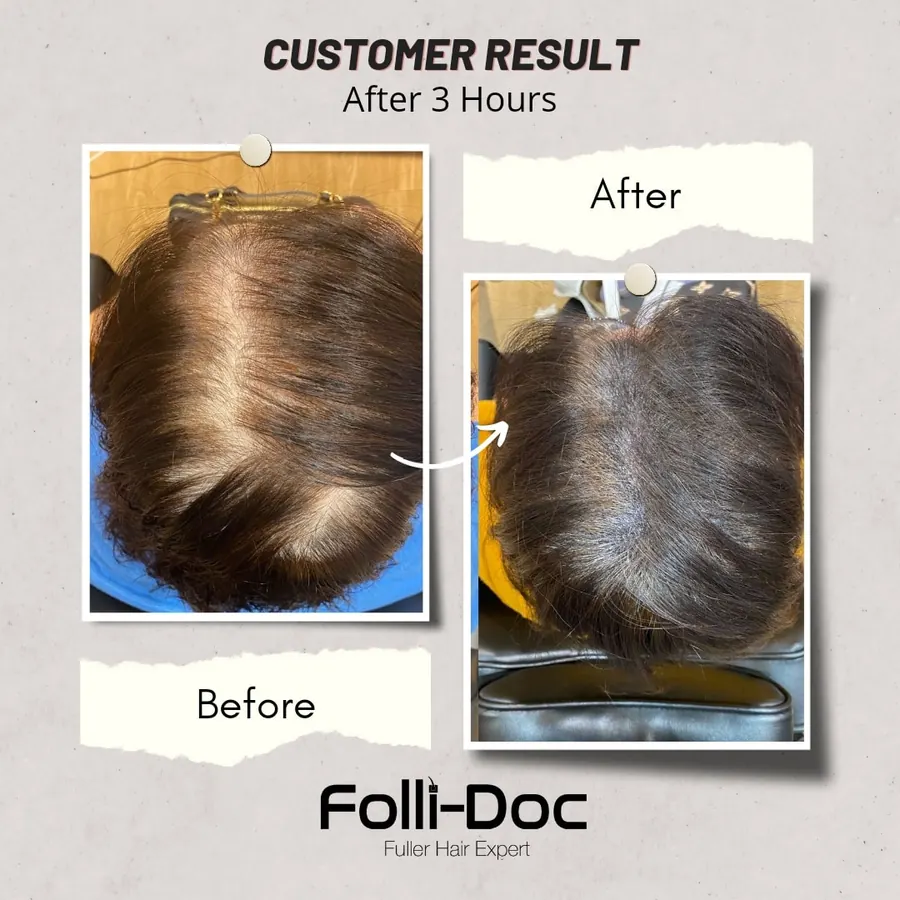 Folli-Doc customer result, before and after one session