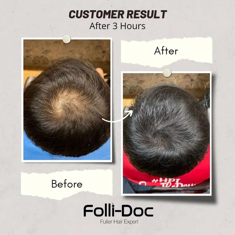 Folli-Doc customer result, before and after one session