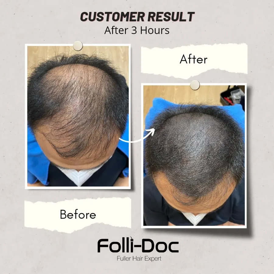Folli-Doc customer result, before and after one session