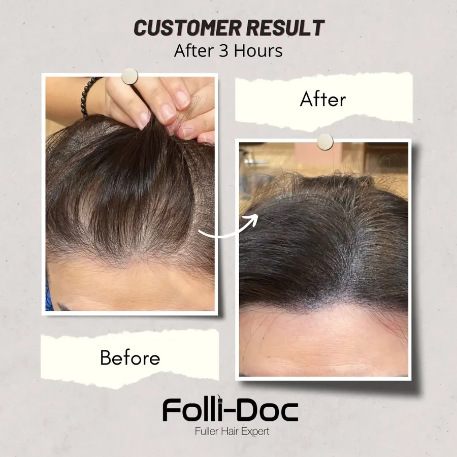 Folli-Doc customer result, before and after one session