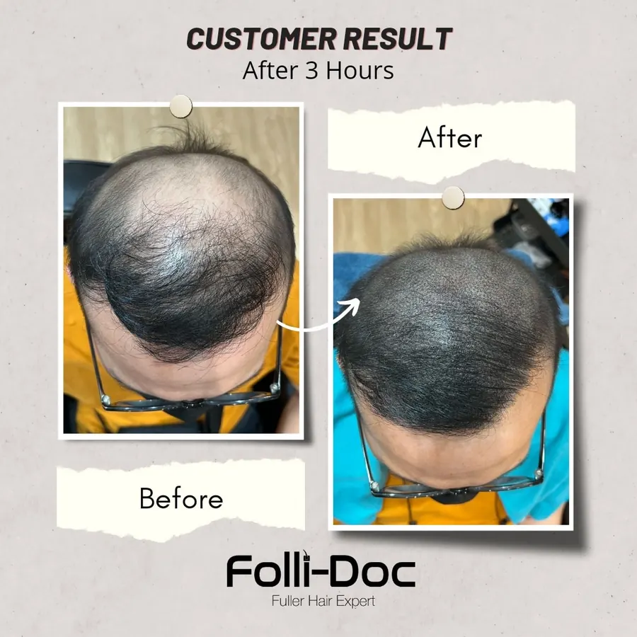 Folli-Doc customer result, before and after one session