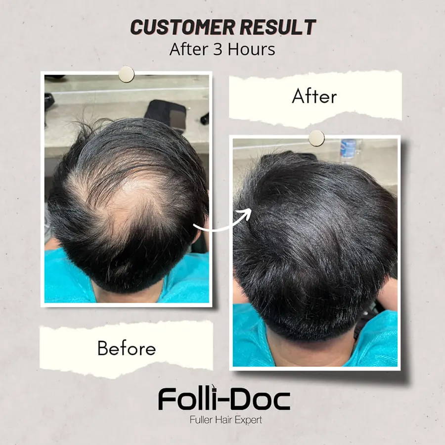 Folli-Doc customer result after 3–4 hours