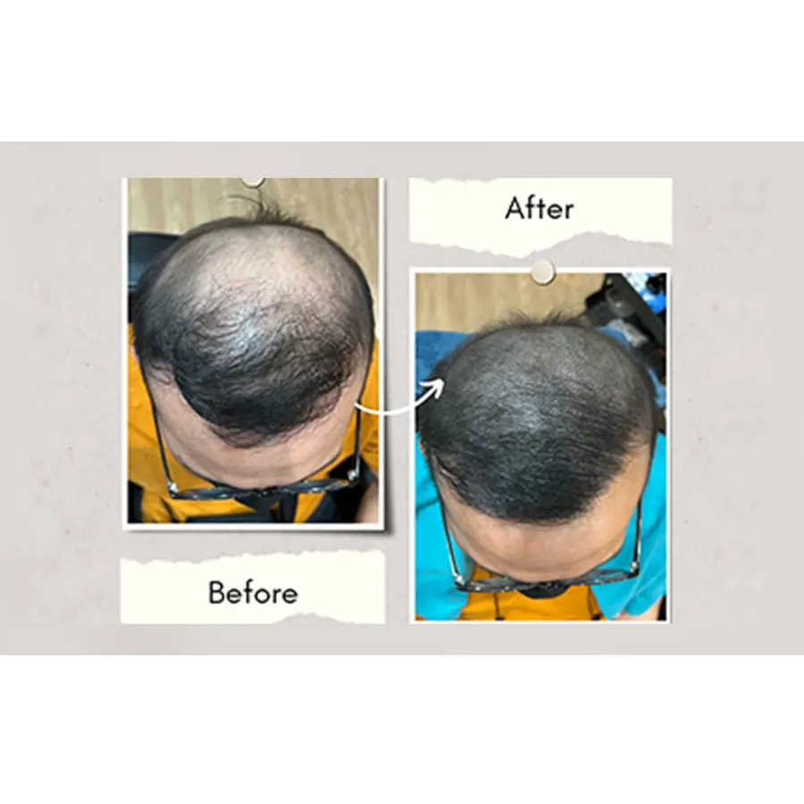 Folli-Doc customer result, before and after one session